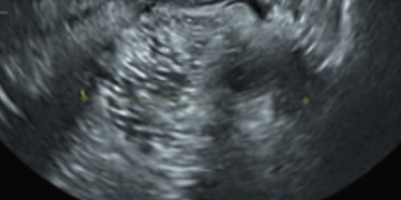 Guida al Counselling di Settembre 2025: teratoma cistico maturo