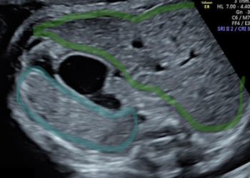 Guida al Counselling di Ottobre 2025: epatosplenomegalia