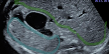 Guida al Counselling di Ottobre 2025: epatosplenomegalia