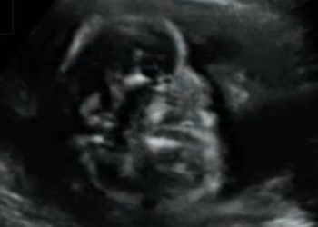 Guida al Counselling di Novembre 2025: estrofia della cloaca