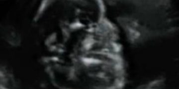 Guida al Counselling di Novembre 2025: estrofia della cloaca