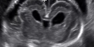 Guida al Counselling di Febbraio 2026: microcefalia