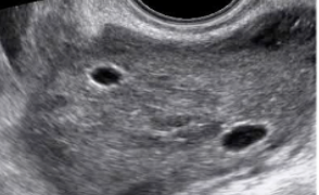 Guida al Counselling di Marzo 2026: torsione ovarica