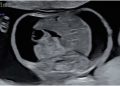 Guida al Counselling di Agosto 2026: ascite fetale