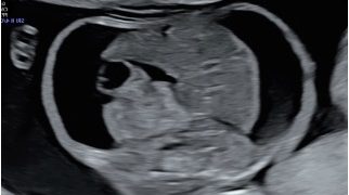 Guida al Counselling di Agosto 2026: ascite fetale