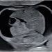 Guida al Counselling di Agosto 2026: ascite fetale