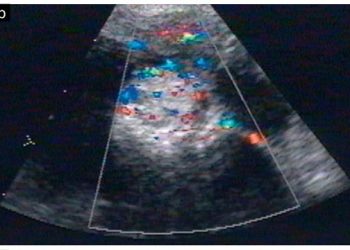 Guida al Counselling di Settembre 2026: struma ovarii